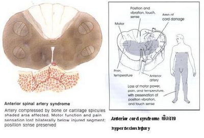 สิ่งที่คาดหวังจากการผ่าตัดเซลล์ประสาทของมอร์ตัน