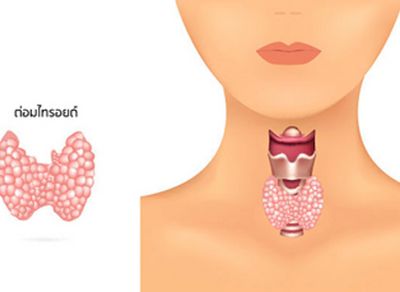 มะเร็งต่อมไทรอยด์ Papillary