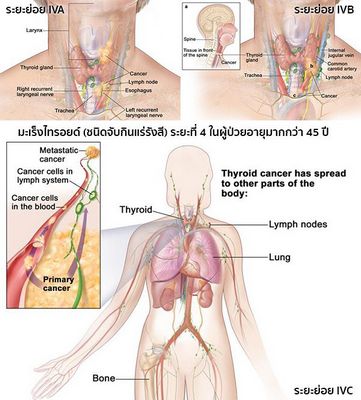 มะเร็งต่อมไทรอยด์ Papillary